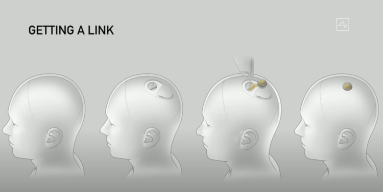 马斯克宣布芯片植入人脑_医疗科技新篇：马斯克确认2025年Neuralink的脑机设备植入计划_马斯克脑植入芯片